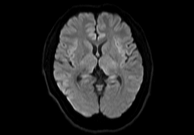 DWI(ディフュージョン：拡散強調画像)