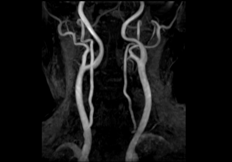 頚部MRA
